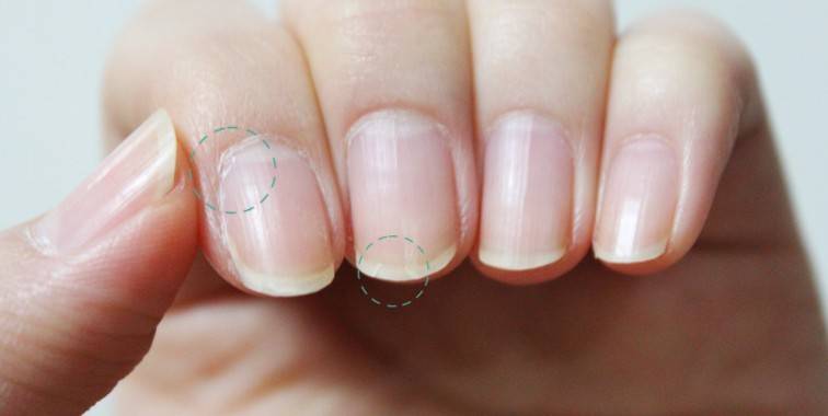 指甲上有豎紋是怎么回事 5個妙招教你如何調(diào)理