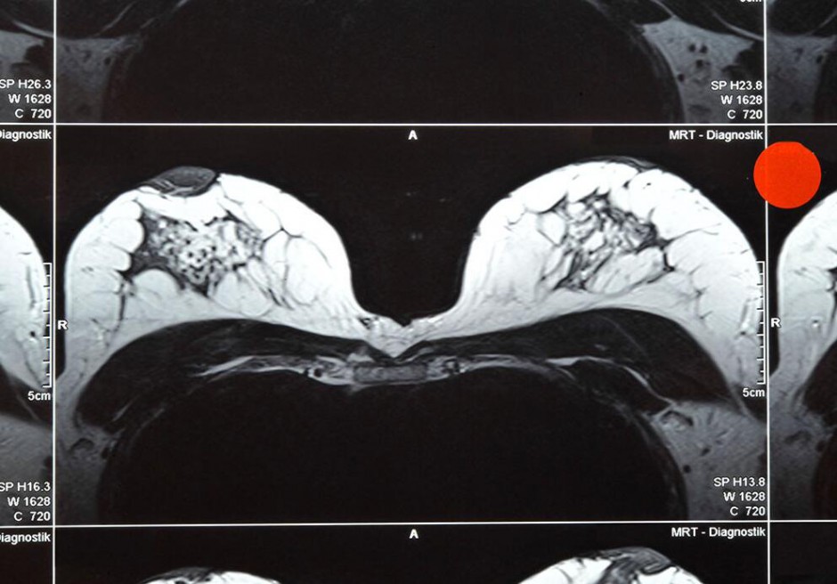 磁共振檢查有哪些優(yōu)勢(shì)  揭乳腺磁共振的作用