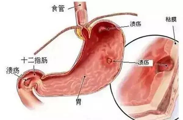 胃出血常見5大癥狀 胃出血最佳治療方法