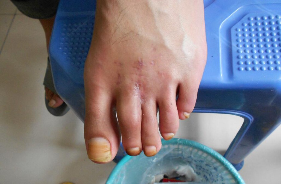 骨髓炎能治好嗎 揭秘骨髓炎癥狀危害