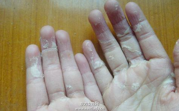 手上脫皮是怎么回事呢 輕松幾招讓你告別脫皮