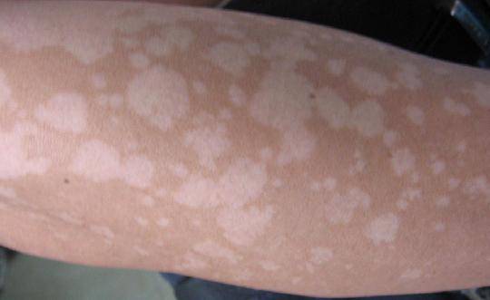 汗斑如何預防 薦5個有效治療小妙招