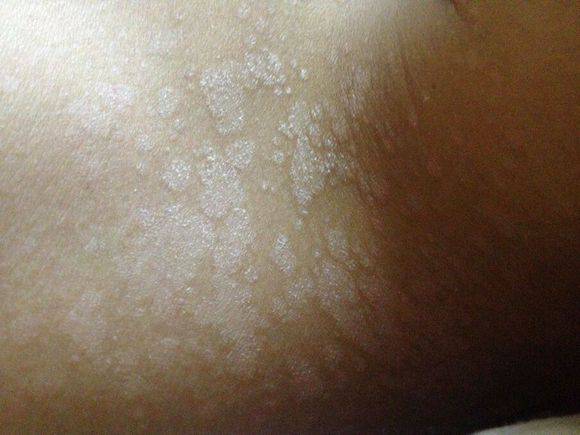 汗斑如何預防 薦5個有效治療小妙招