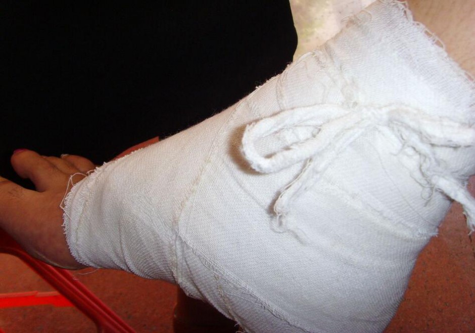 骨折愈合時(shí)間需要多久 愈合康復(fù)訓(xùn)練