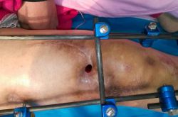 骨髓炎能治好嗎 揭秘骨髓炎癥狀危害