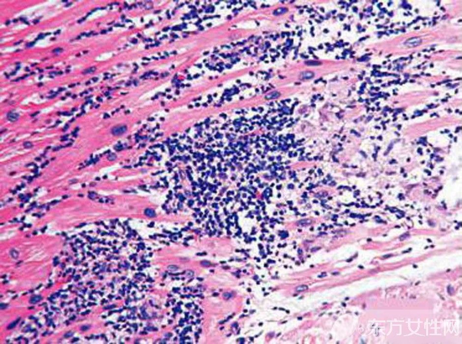 心肌炎是怎么引起的 稍不注意有可能猝死你知道嗎
