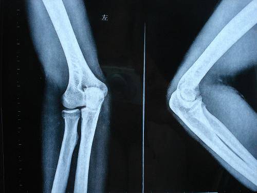 骨折愈合時(shí)間需要多久 愈合康復(fù)訓(xùn)練