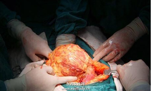 肝囊腫是怎么形成的 應(yīng)該注意哪方面的飲食習(xí)慣