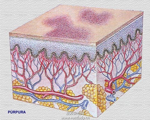 毛細血管破裂是怎么回事 揭秘毛細血管破裂的癥狀