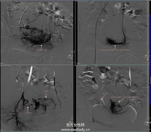 中晚期肝癌介入治療的方法有哪些