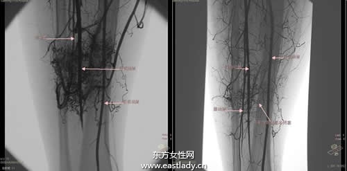 中晚期肝癌介入治療的方法有哪些