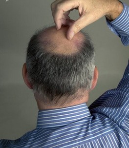 脫發(fā)怎么辦 預(yù)防男人脫發(fā)吃什么好