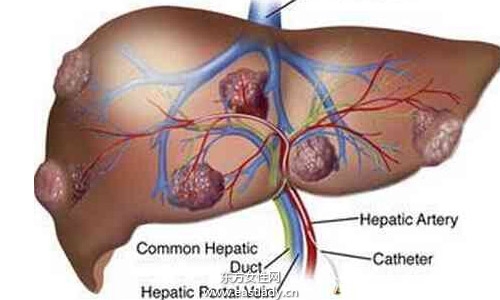 肝囊腫是怎么形成的 應(yīng)該注意哪方面的飲食習(xí)慣