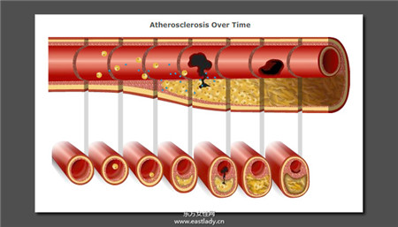 血管硬化怎么辦 6 種方法能夠幫血管洗澡