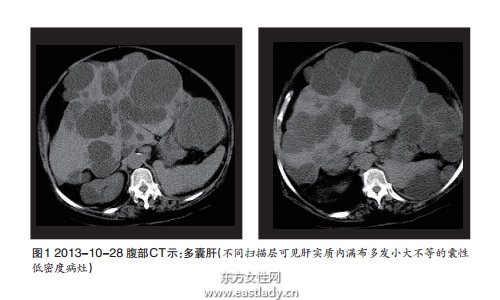 肝囊腫是怎么形成的 應(yīng)該注意哪方面的飲食習(xí)慣