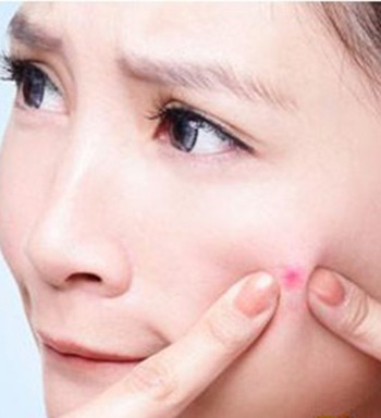 長痘痘怎么辦 長痘痘能不能用手?jǐn)D