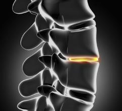 注意了 常見的這些動作會加速你的骨骼老化