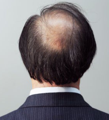 男人如何防脫發(fā) 男人脫發(fā)怎么辦 試試這方法