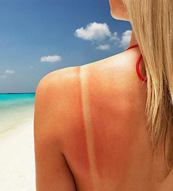 夏季曬傷了怎么辦 推薦幾款自制曬后修復(fù)面膜