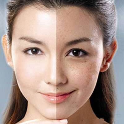 不想做個(gè)斑斑女人？教你怎樣祛斑