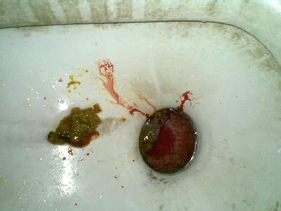 大便出血是什么原因以及大便出血怎么辦