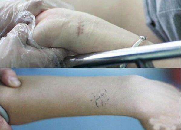 最后的補(bǔ)救措施 人流后多久可以出門