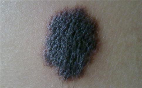 黑色素瘤和痣傻傻分不清 黑色素瘤和痣的區(qū)別