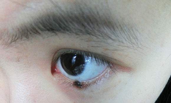 黑色素瘤和痣傻傻分不清 黑色素瘤和痣的區(qū)別