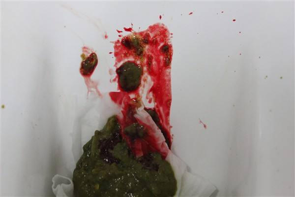 大便出血是什么原因以及大便出血怎么辦