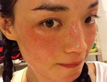 臉部過敏發(fā)紅怎么辦以及它的注意事項(xiàng)是什么