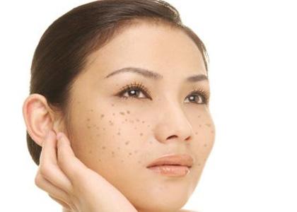 民間祛斑秘方 這10個(gè)方法讓你不在煩惱