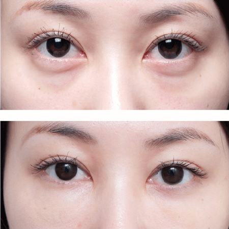 怎么樣去除眼袋，這三種方法你值得擁有