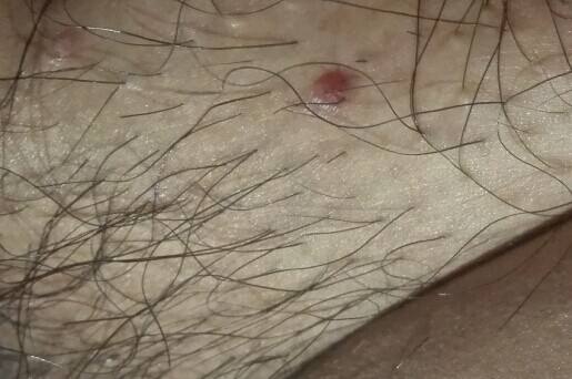 皰疹是怎么引起的以及治療方法是什么