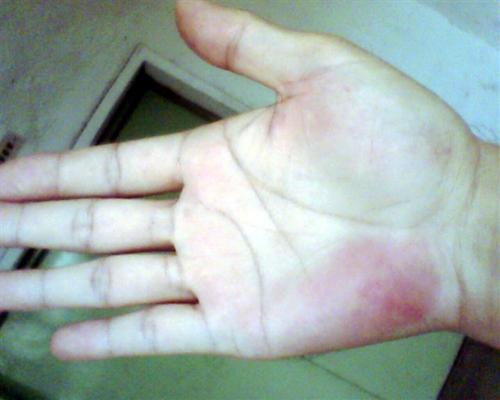 手脫皮怎么辦，三招立馬解決