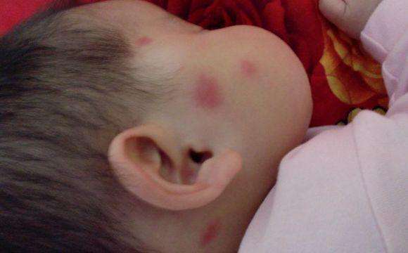 撓撓撓皮膚瘙癢起紅疙瘩怎么辦