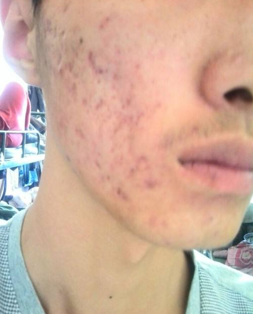 痘印怎么消除小妙招，這四種你要知道