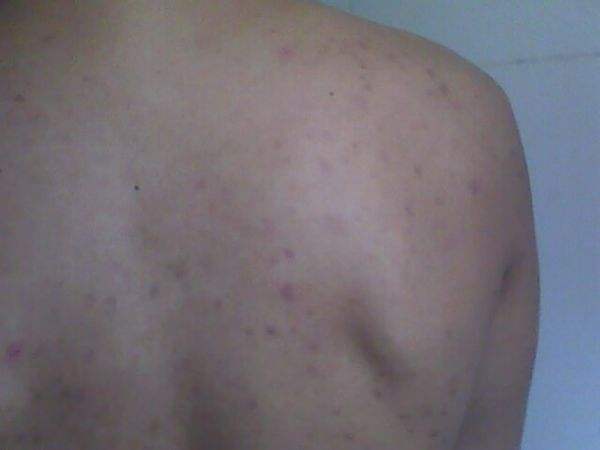 后背長(zhǎng)痘痘是什么原因，可能是這6種原因