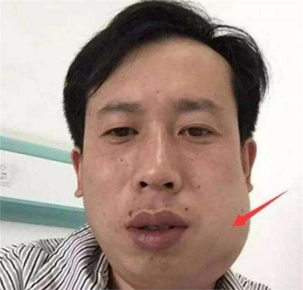 俊美的臉被打腫了怎么辦你知道嗎
