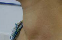 甲亢的早期癥狀  氣喘  心律不齊 心絞痛