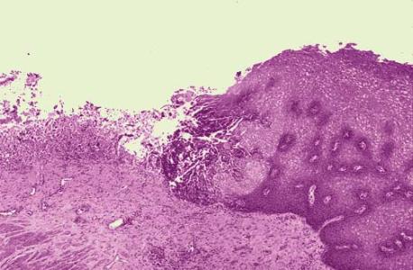 皰疹是怎么引起的以及治療方法是什么