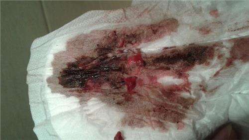 月經不調毛病多 月經量少發(fā)黑的原因