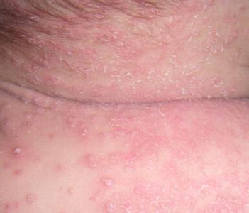 各種皮膚病治療的小偏方 讓你快速康復