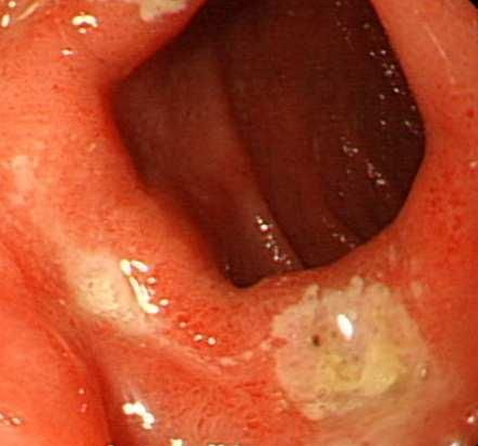 十二指腸炎的癥狀  表現(xiàn)有疼痛癥狀