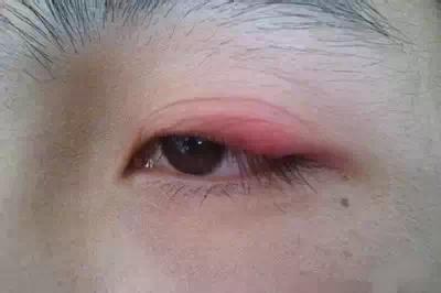 眼睛的門戶 割雙眼皮的壞處