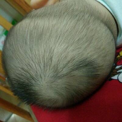 頭發(fā)少怎么辦  治療脫發(fā)的偏方