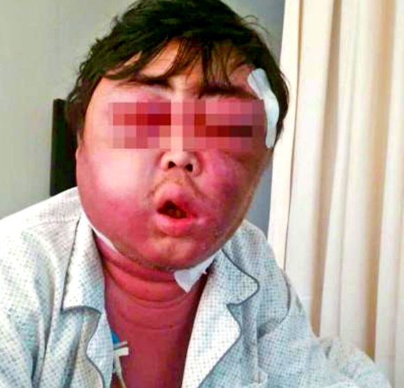 俊美的臉被打腫了怎么辦你知道嗎