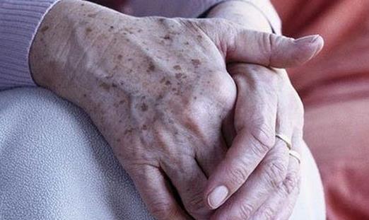 得了老年斑不可怕，老年斑有消除辦法