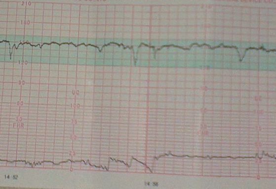 什么叫胎心監(jiān)護(hù) 胎心監(jiān)護(hù)的作用是什么
