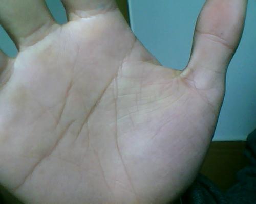 手脫皮怎么辦，三招立馬解決