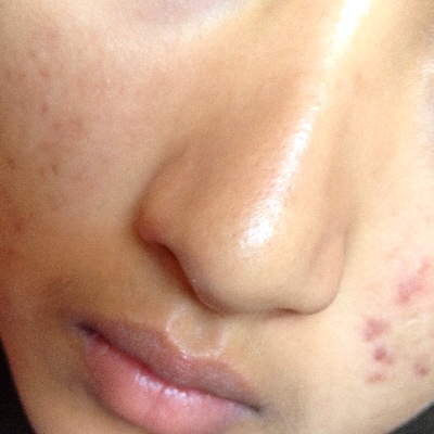 鼻子上有黑頭怎么辦  教你幾招